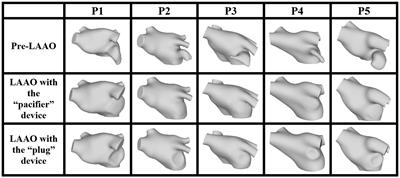 Preliminary findings on left atrial appendage occlusion simulations applying different endocardial devices